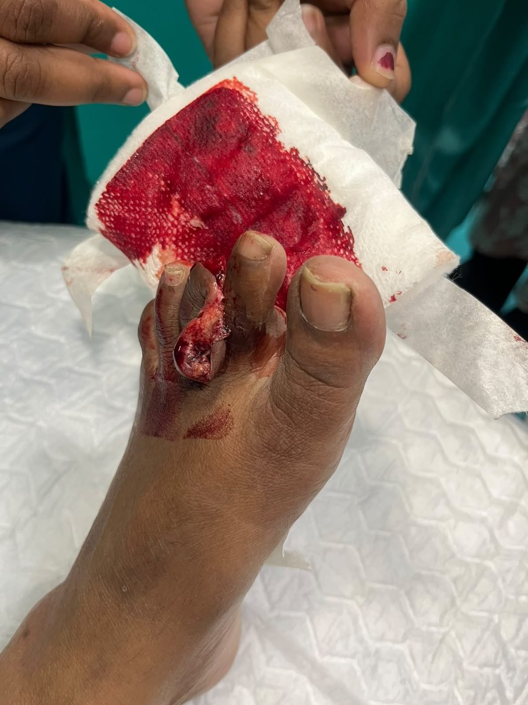 Crush injury of the toes before surgical repair