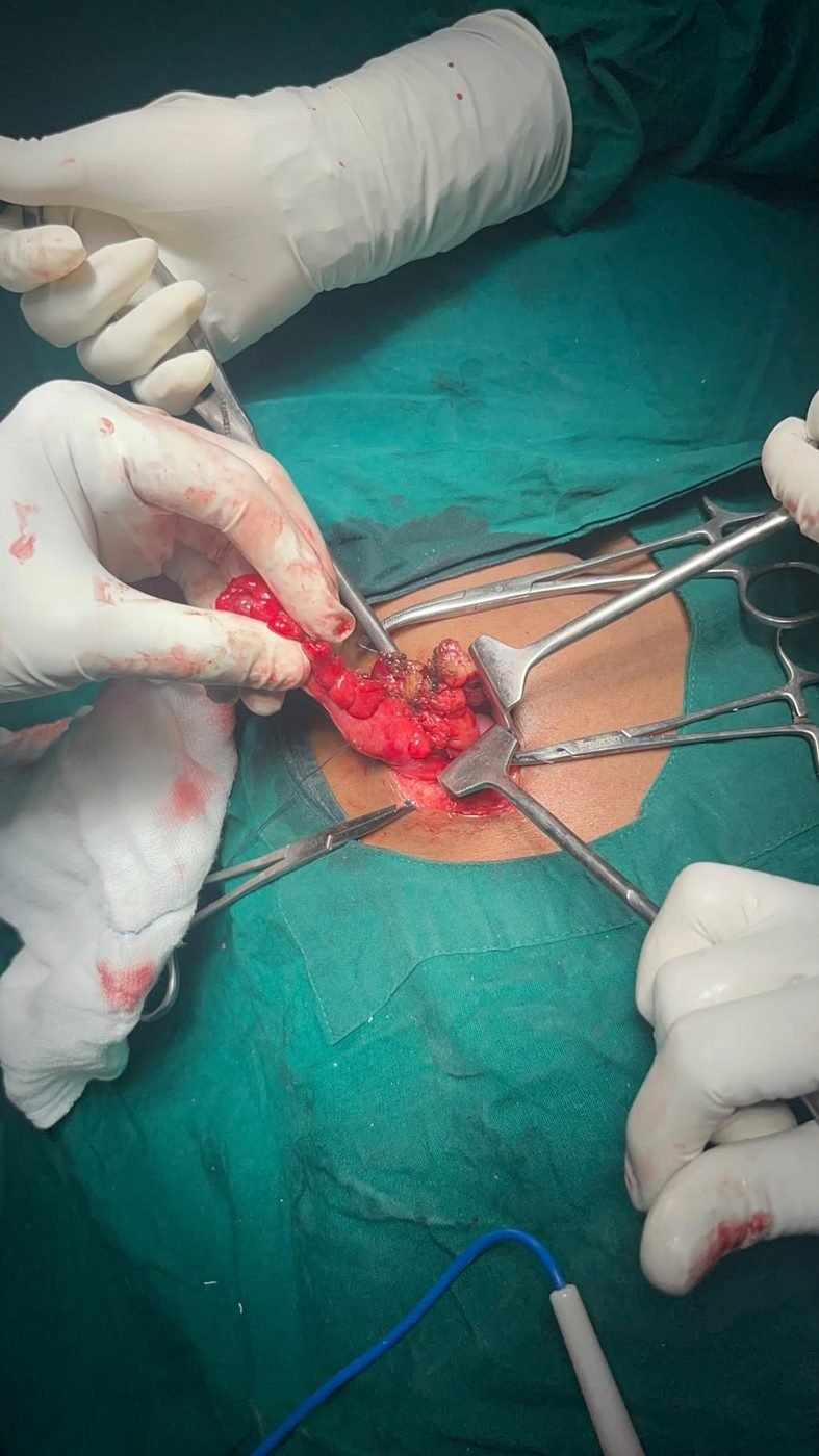 Surgeons performing an open abdominal procedure