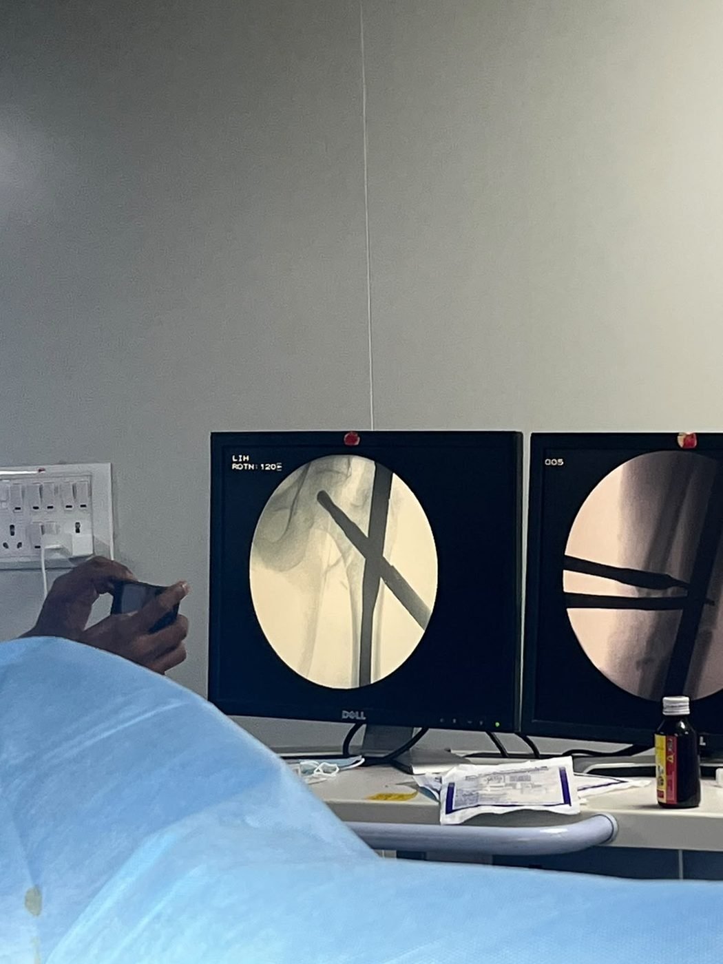Intra-operative fluoroscopy showing a nail fixing a hip fracture