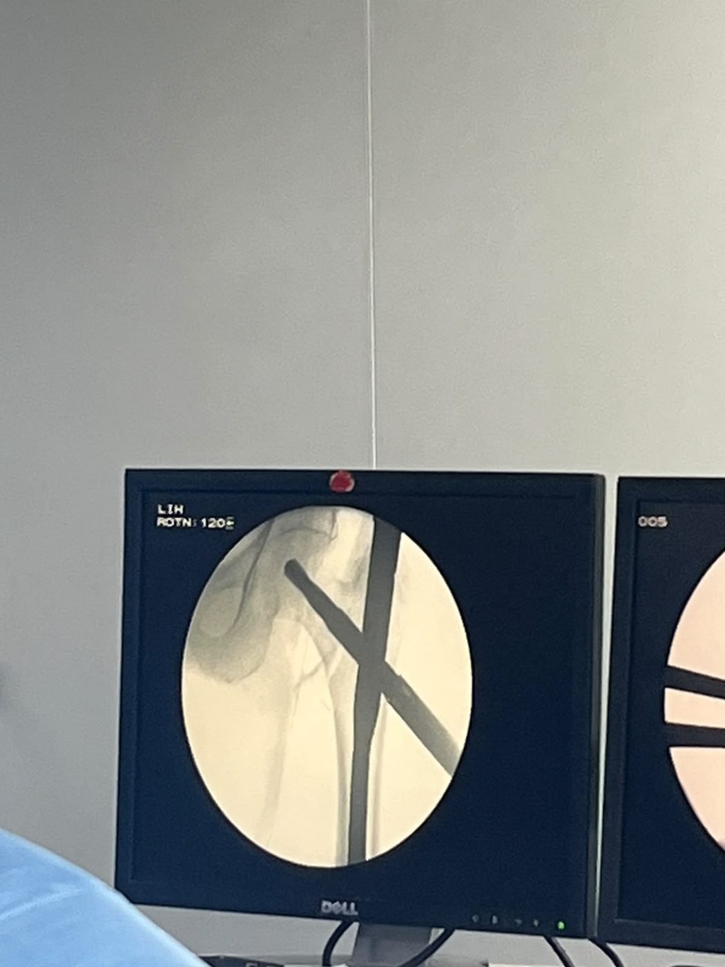 Close view of fluoroscopy confirming hip nail position