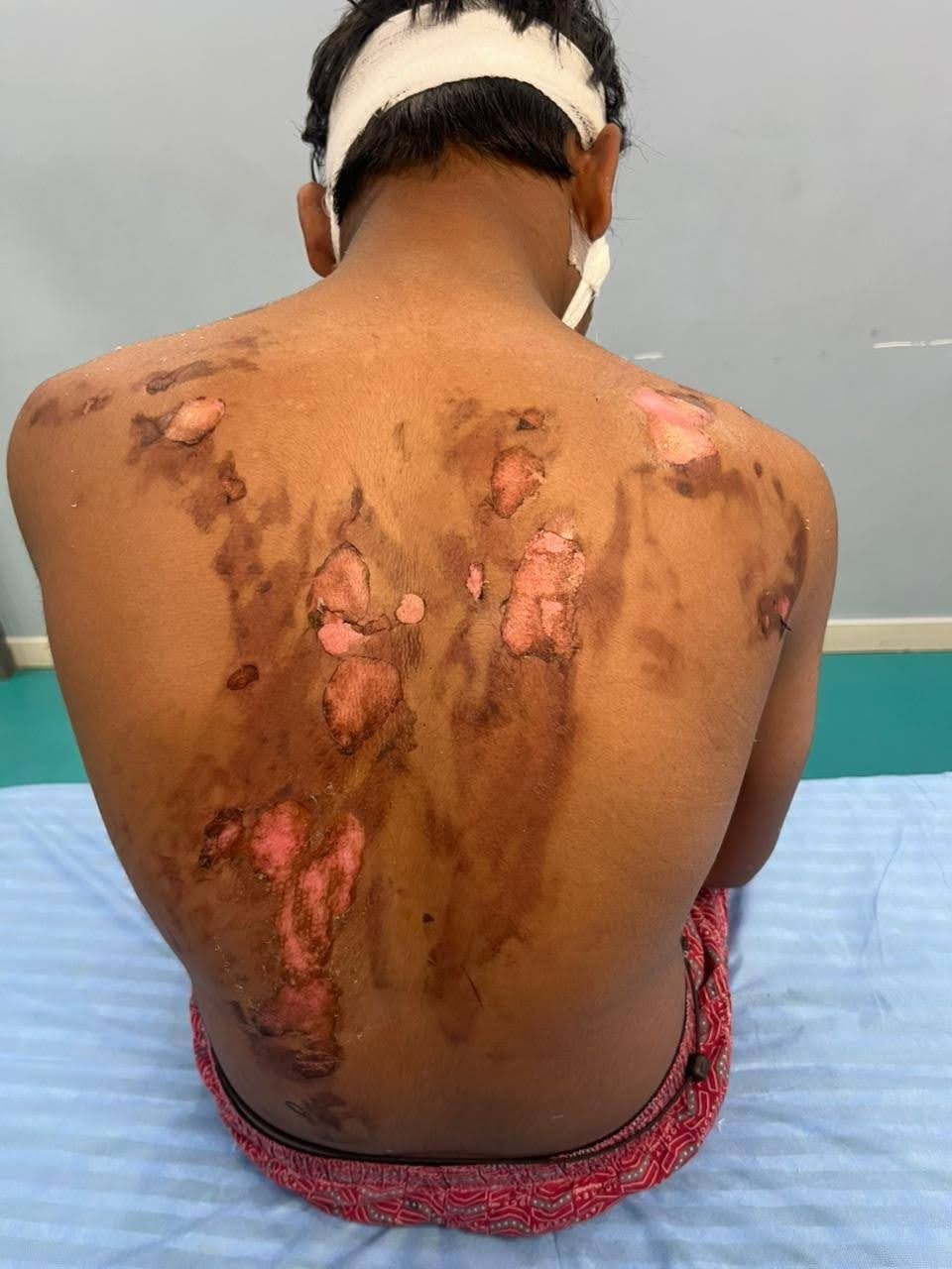 Burn injuries on the back of a patient during treatment