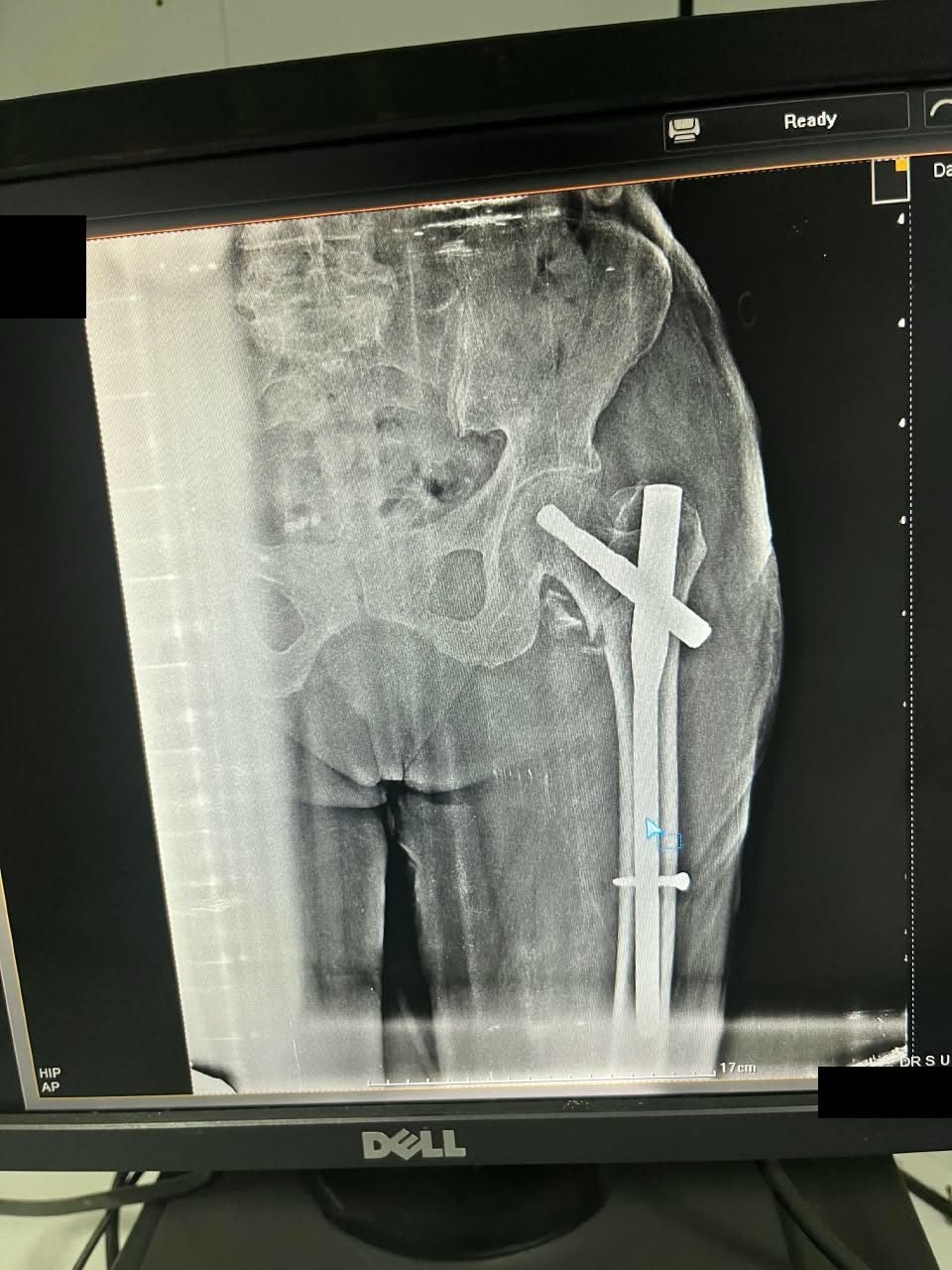 Post-operative X-ray showing a hip fracture fixed with an intramedullary nail