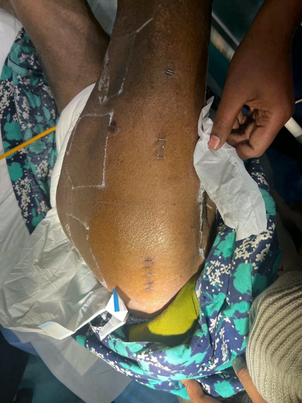 Knee after surgery with skin staples in place